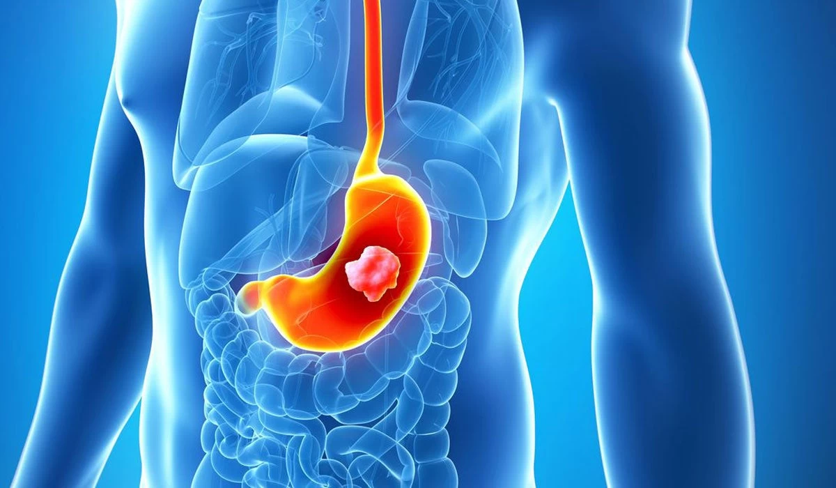 Καρκίνος του στομάχου: Αυτά είναι τα «αθόρυβα» συμπτώματα που θα πρέπει να προσέξετε